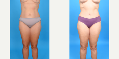 Case 44 - 35-44 year old woman treated with Abdominal Etching, Diastasis Recti Repair, Drainless Tummy Tuck, Liposculpture, Liposuction, M