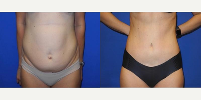 Case 440 - 40 year old woman treated with Tummy Tuck