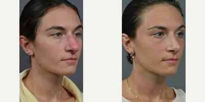 Case 4400 - Woman treated with Rhinoplasty