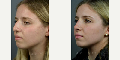 Case 4404 - Woman treated with Rhinoplasty