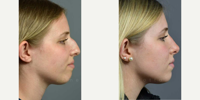 Case 4405 - Woman treated with Rhinoplasty