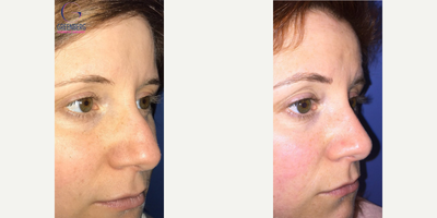 Case 4406 - Woman treated with Rhinoplasty