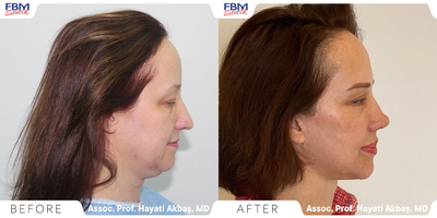 Case 4407 - 45-54 year old woman treated with Deep Plane Facelift, Neck Lift, Double Eyelid Surgery, Facial Fat Transfer, Rhinoplasty
