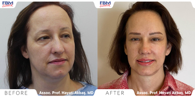 Case 4408 - 45-54 year old woman treated with Deep Plane Facelift, Neck Lift, Double Eyelid Surgery, Facial Fat Transfer, Rhinoplasty