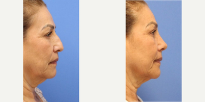 Case 4410 - Woman treated with Rhinoplasty