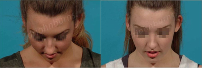 Case 4413 - Woman treated with Rhinoplasty
