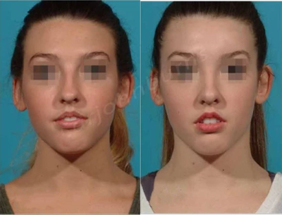 Case 4414 - Woman treated with Rhinoplasty