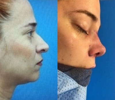 Case 4419 - Woman treated with Rhinoplasty