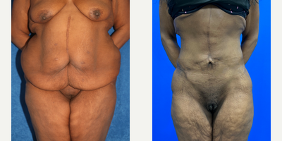 Case 442 - 35-44 year old woman treated with Tummy Tuck