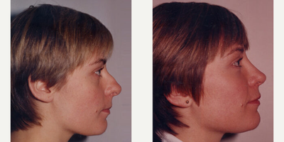 Case 4420 - Woman treated with Rhinoplasty