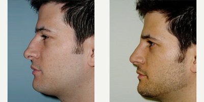 Case 4421 - Man treated with Rhinoplasty