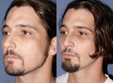 Case 4422 - Man treated with Rhinoplasty