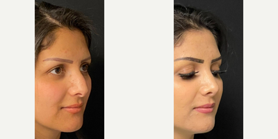 Case 4424 - Woman treated with Rhinoplasty