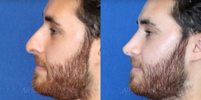 Case 4425 - Woman treated with Rhinoplasty