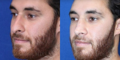 Case 4426 - Woman treated with Rhinoplasty