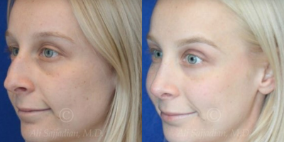Case 4427 - Woman treated with Rhinoplasty