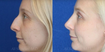Case 4428 - Woman treated with Rhinoplasty