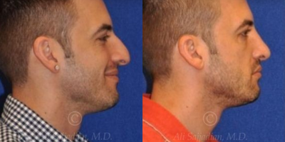 Case 4429 - Woman treated with Rhinoplasty
