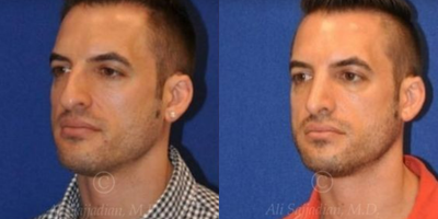 Case 4430 - Woman treated with Rhinoplasty