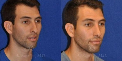 Case 4431 - Woman treated with Rhinoplasty