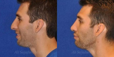 Case 4432 - Woman treated with Rhinoplasty