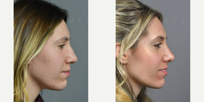 Case 4433 - Woman treated with Rhinoplasty