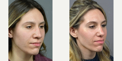 Case 4434 - Woman treated with Rhinoplasty
