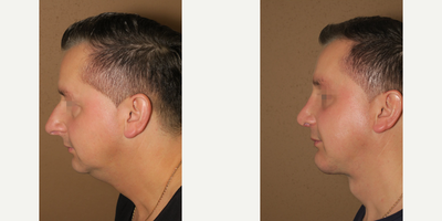 Case 4435 - Man treated with Rhinoplasty