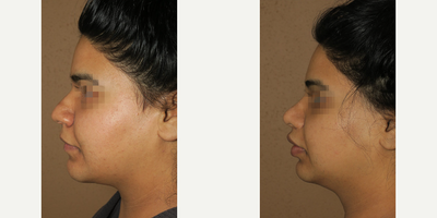 Case 4436 - Woman treated with Rhinoplasty