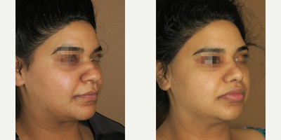 Case 4437 - Woman treated with Rhinoplasty