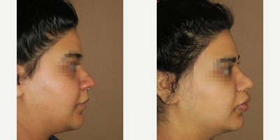 Case 4438 - Woman treated with Rhinoplasty