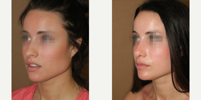 Case 4439 - Woman treated with Rhinoplasty