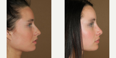Case 4440 - Woman treated with Rhinoplasty