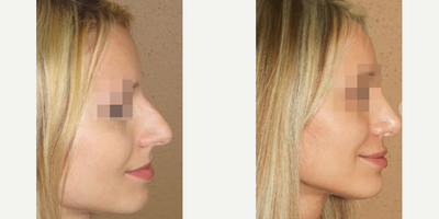 Case 4441 - Woman treated with Rhinoplasty
