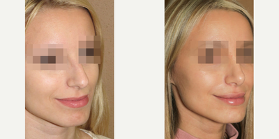 Case 4442 - Woman treated with Rhinoplasty