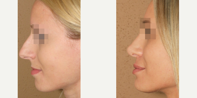 Case 4443 - Woman treated with Rhinoplasty