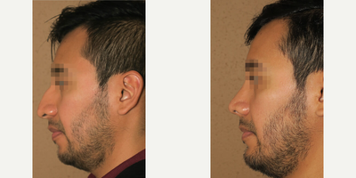 Case 4444 - Man treated with Rhinoplasty