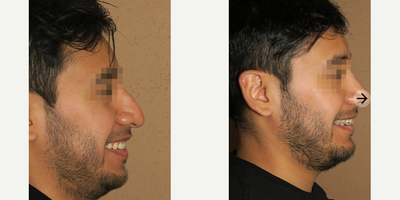 Case 4445 - Man treated with Rhinoplasty
