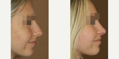 Case 4446 - Woman treated with Rhinoplasty