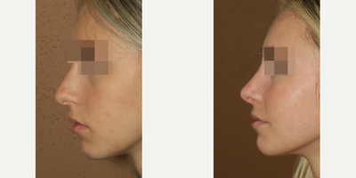 Case 4447 - Woman treated with Rhinoplasty