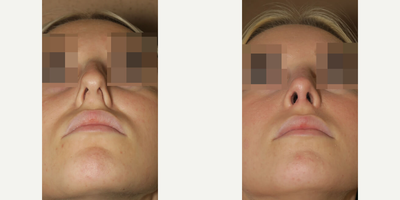 Case 4448 - Woman treated with Rhinoplasty