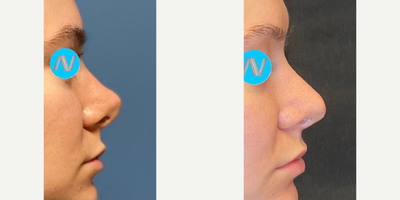 Case 4449 - Woman treated with Rhinoplasty