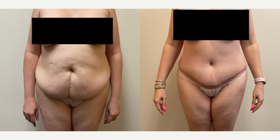 Case 445 - Woman treated with Tummy Tuck