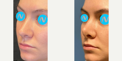 Case 4450 - Woman treated with Rhinoplasty