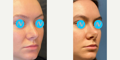 Case 4451 - Woman treated with Rhinoplasty