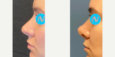 Case 4452 - Woman treated with Rhinoplasty