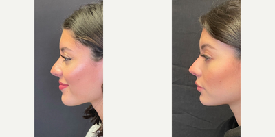 Case 4453 - Woman treated with Rhinoplasty