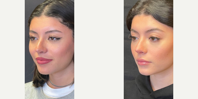 Case 4454 - Woman treated with Rhinoplasty