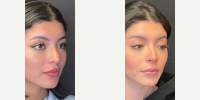 Case 4455 - Woman treated with Rhinoplasty