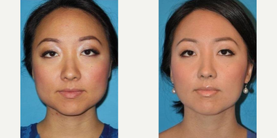 Case: 4457 - before and after photo of Woman treated with Botox by Barry M. Weintraub, MD, FACS